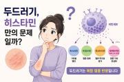 두드러기, 히스타민만의 문제일까? 비만세포 염증 반응까…