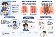 치질 줄혈, 상처가 아니라 혈관 문제일 수 있습니다